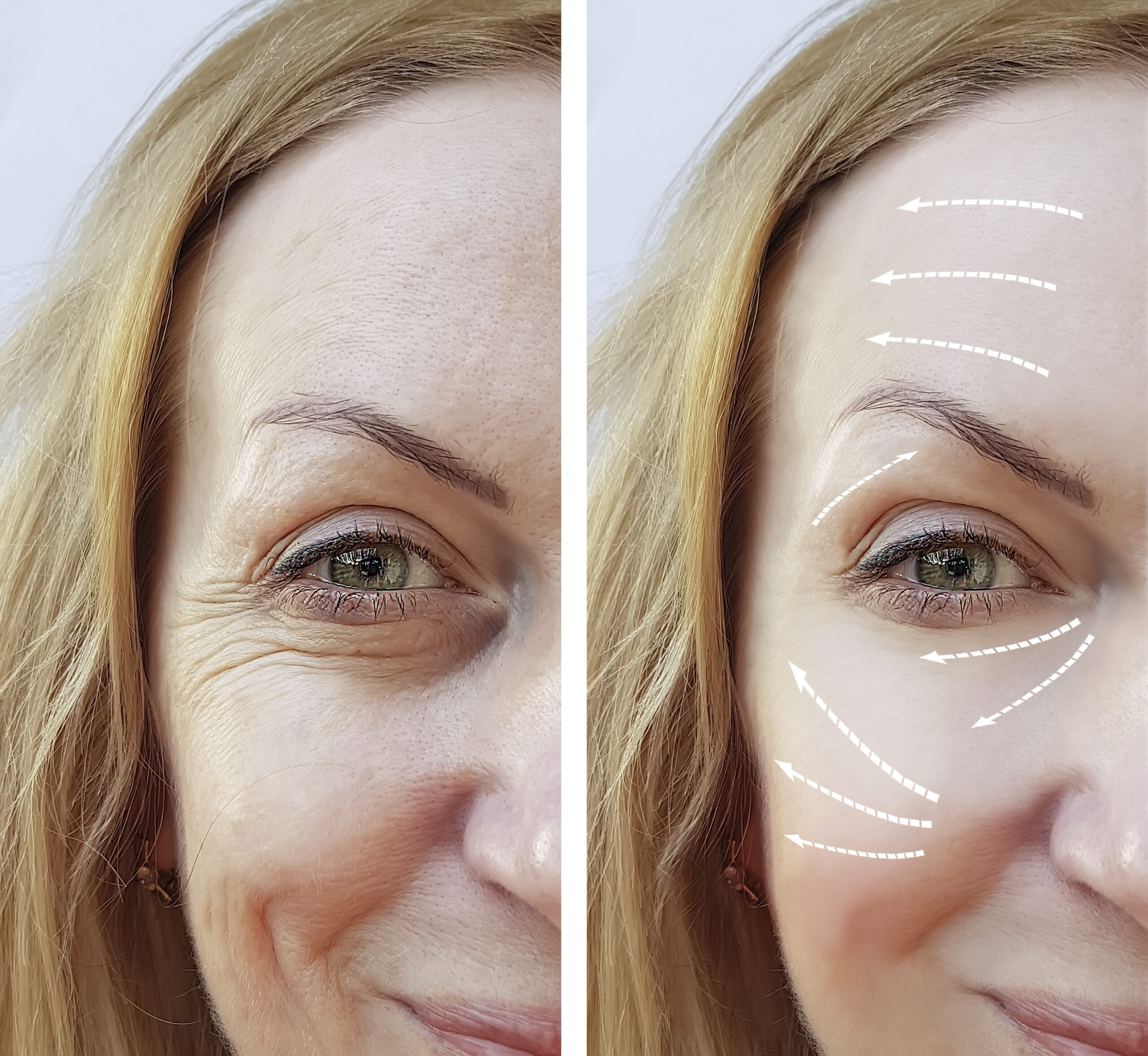 woman wrinkles before and after the procedure PRX PLUS PRX PLUS
